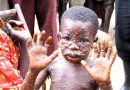 Monkeypox Virus: What is it and should we worry?