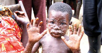 Monkeypox Virus: What is it and should we worry?
